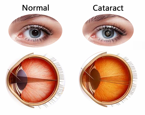 cataract